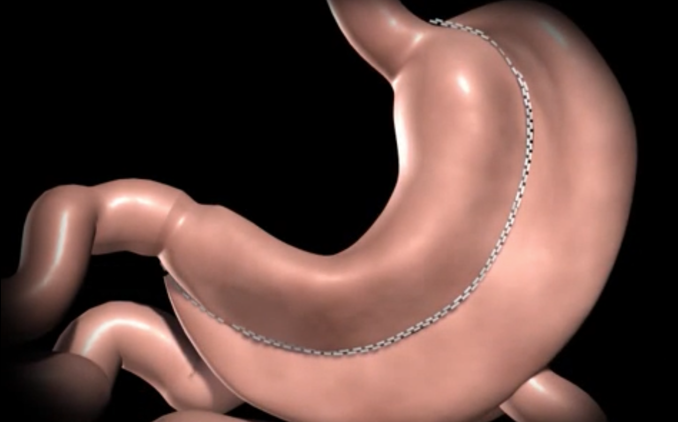 Encreuament Duodenal a Barcelona - Clínica ServiDigest